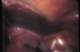 Dev (giant) hiatal herni