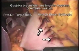 Gastrika breveslerin kesilmesine başlama (KAVŞAK) noktası