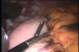Gastriko breveslerin ayrılma (KAVŞAK) noktası