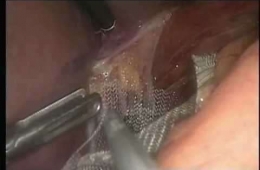 Hiatal hernide mesh yerleştirilmesi