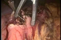 Laparoskopik Endo-Organ Gastrik Tümör Eksizyonu