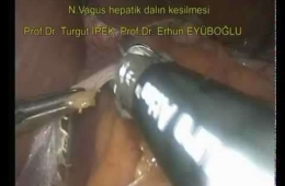 N.Vagus hepatik dalın kesilmesi